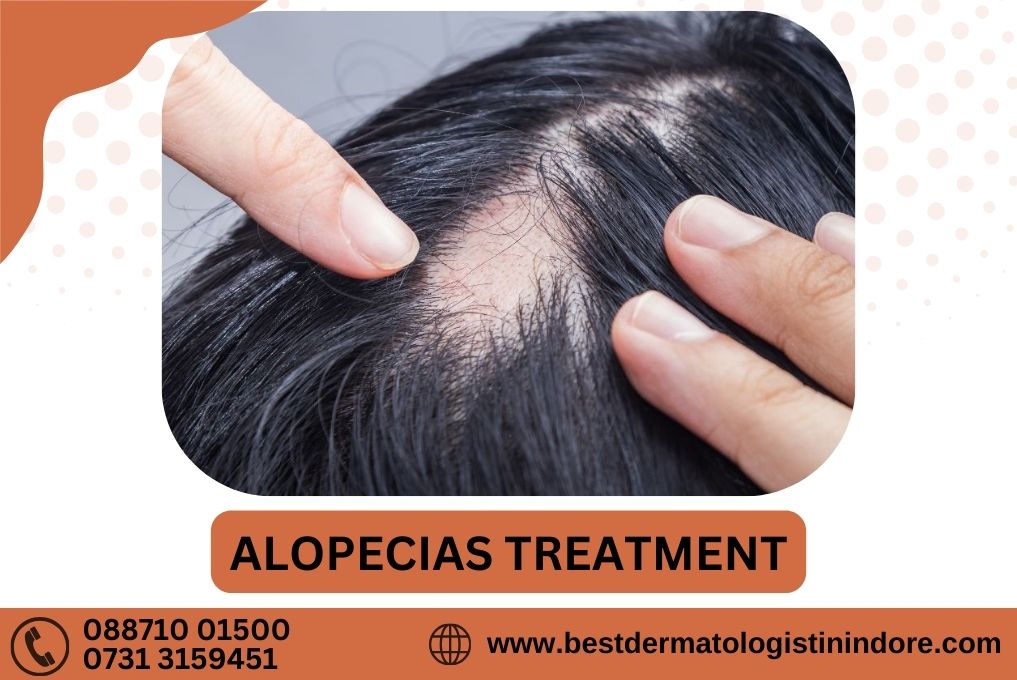 Alopecia Areata Treatment In Indore