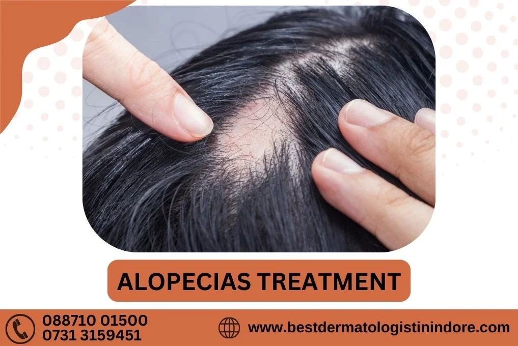 Alopecia Areata Treatment In Indore