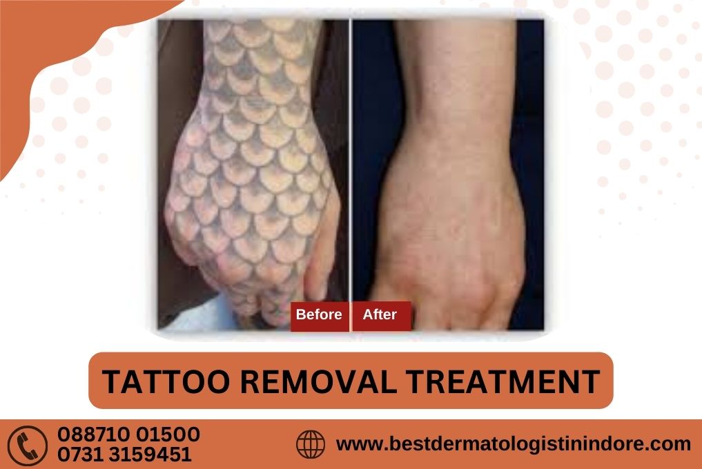 Tattoo Removal Treatment in Indore