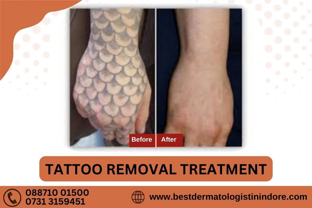 Tattoo Removal Treatment in Indore
