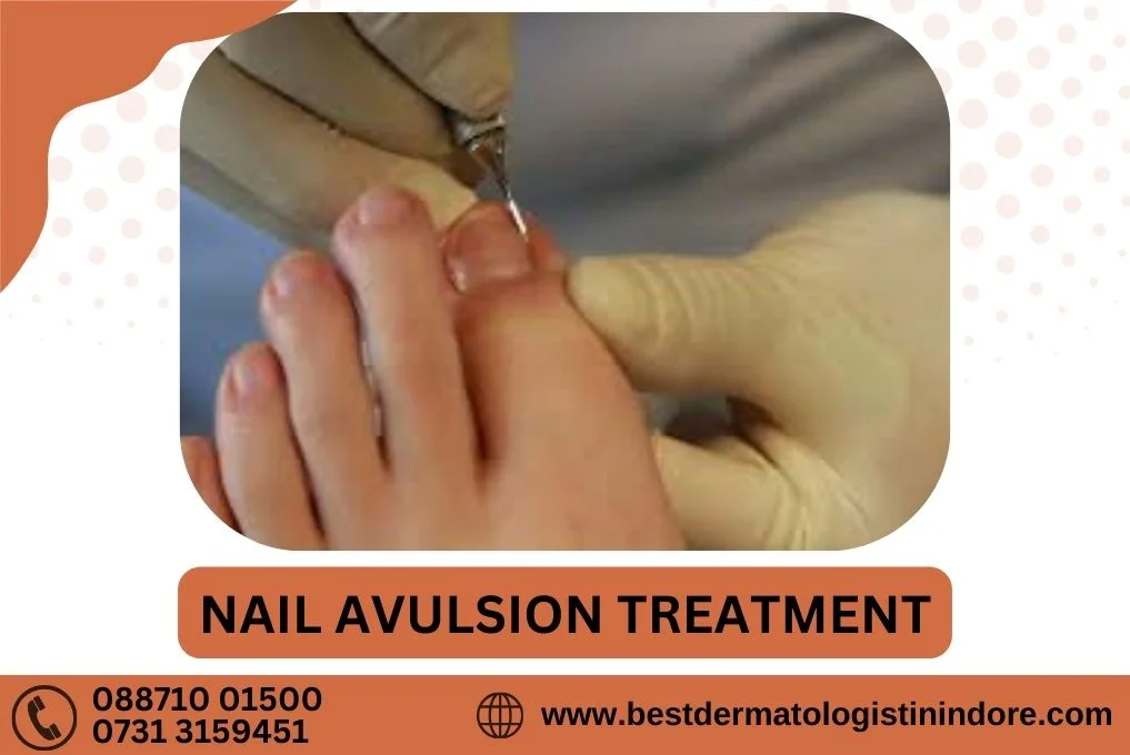 Best Dermatologist for Nail Avulsion in Indore