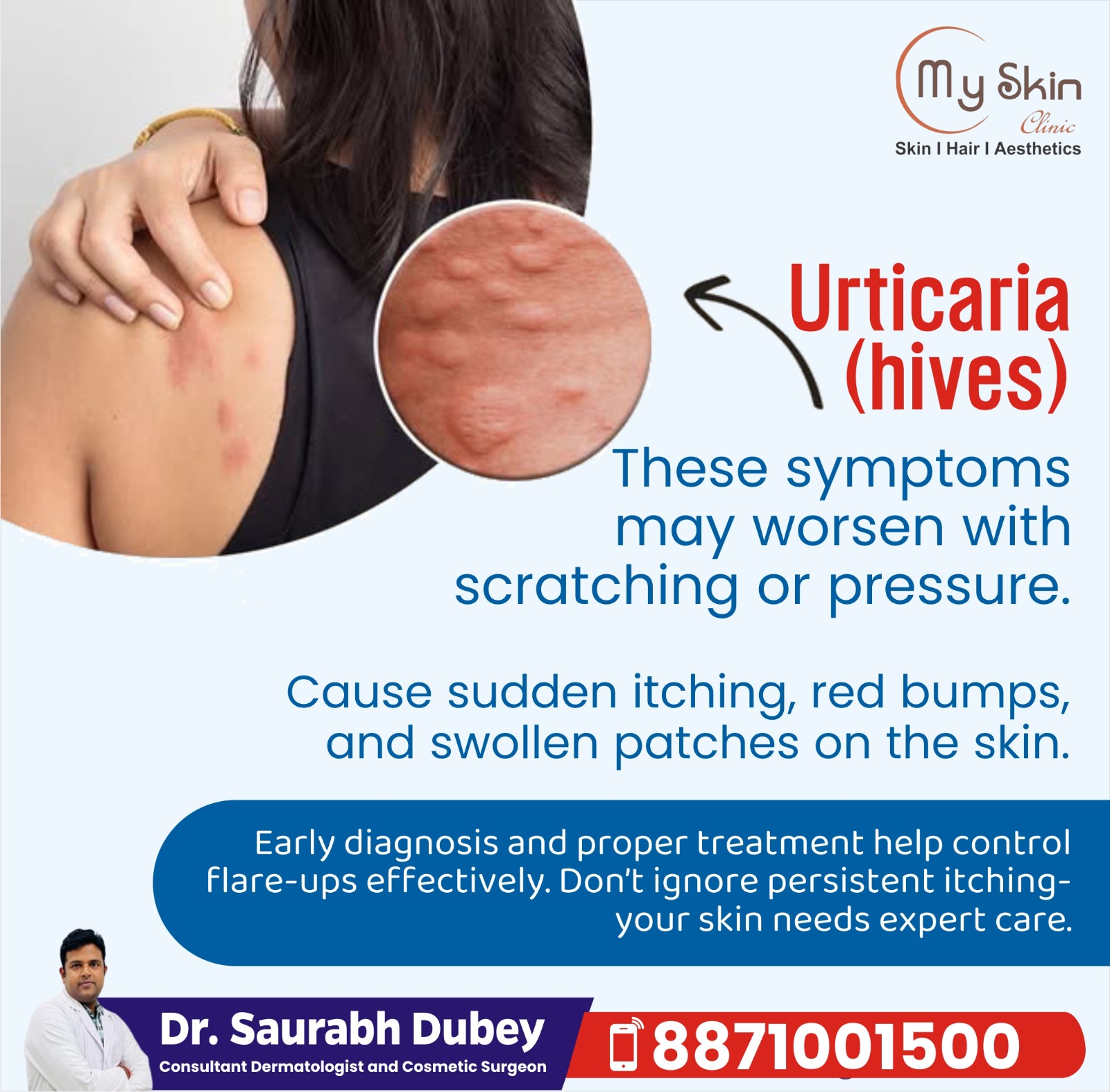 Best Hives Treatment Specialist in Indore