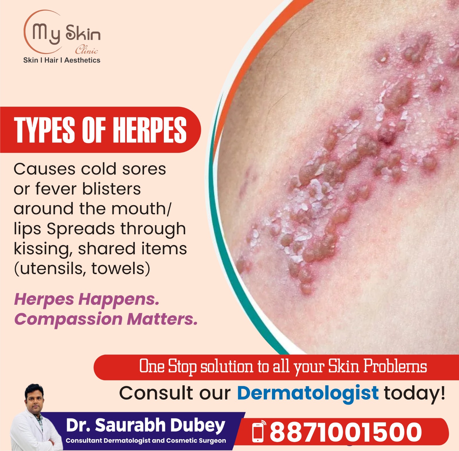 Herpes Specialist in Indore 