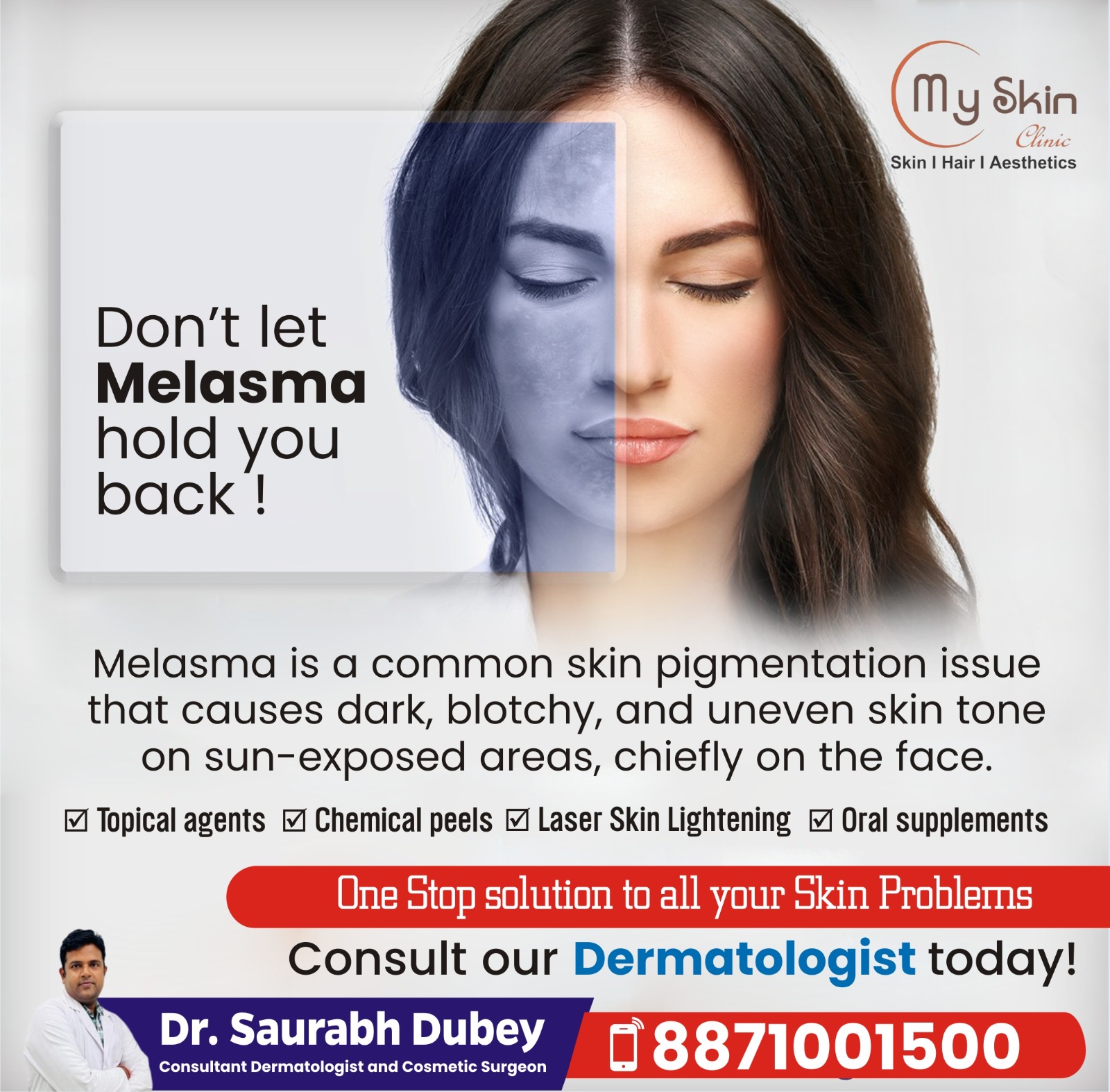 Melasma treatment In Indore
