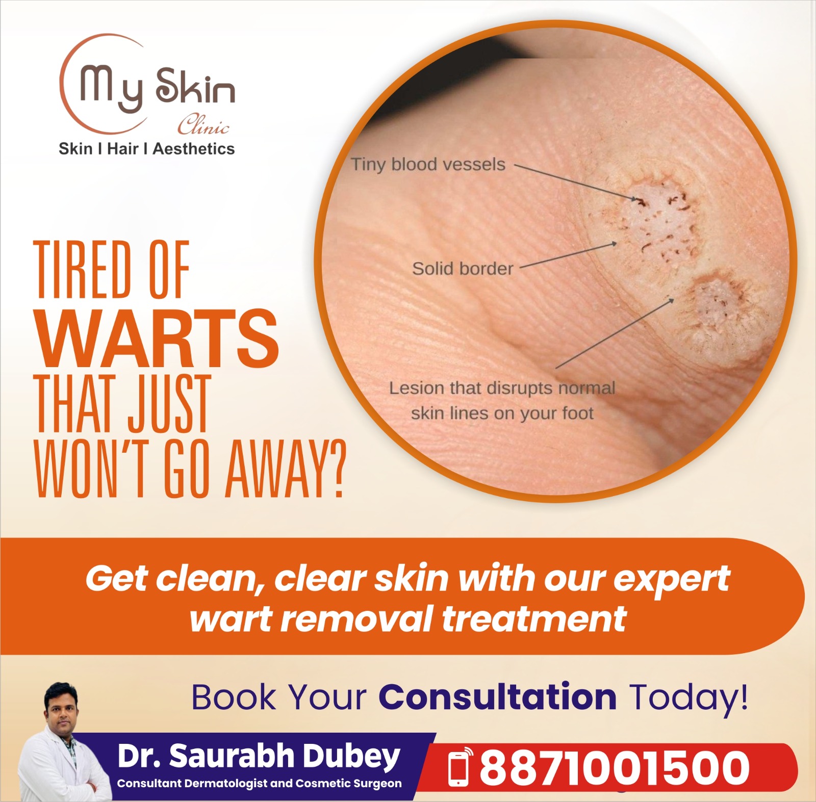 Best Skin Doctor for Warts in Indore