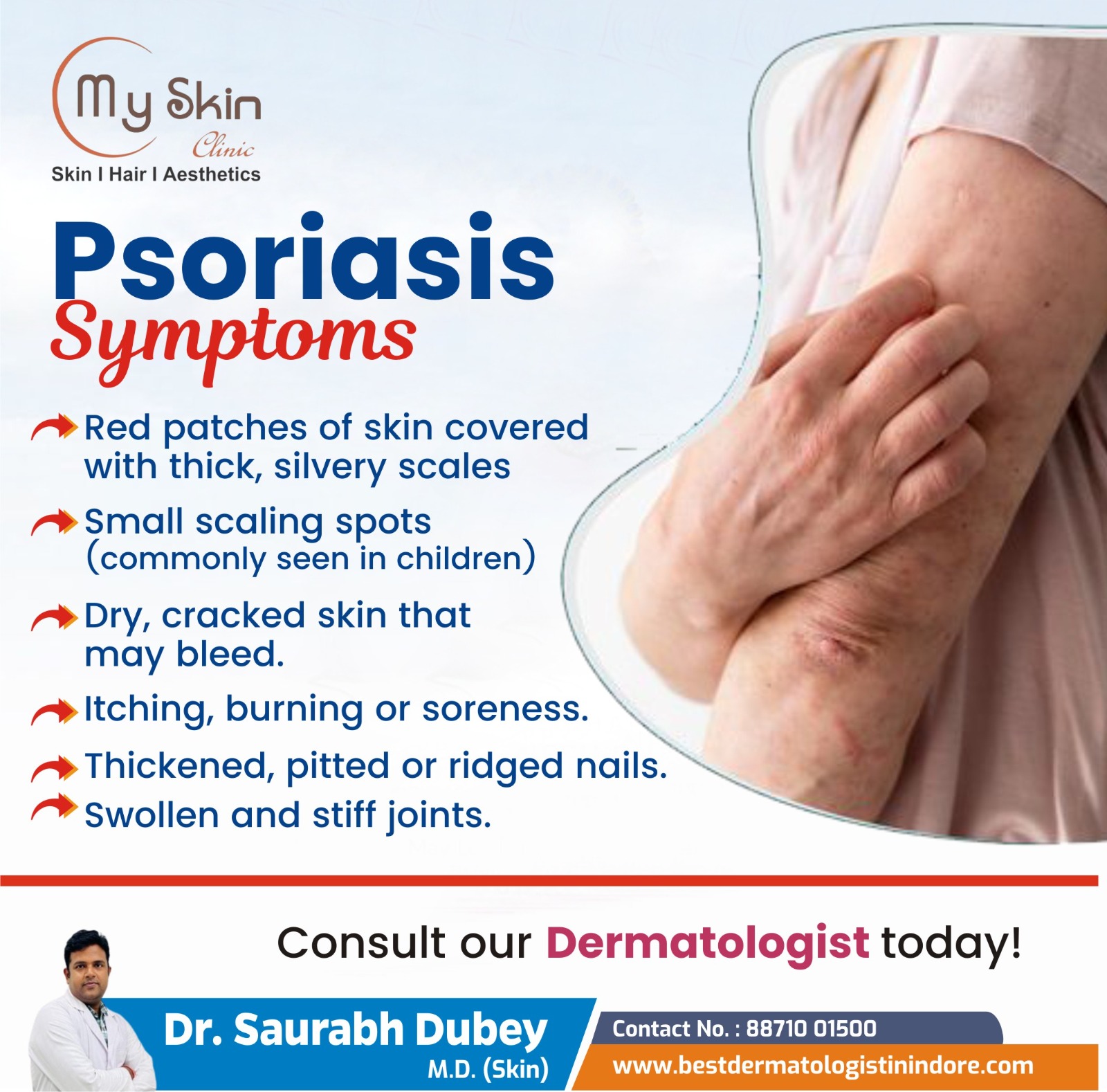 Psoriasis Specialist in Indore