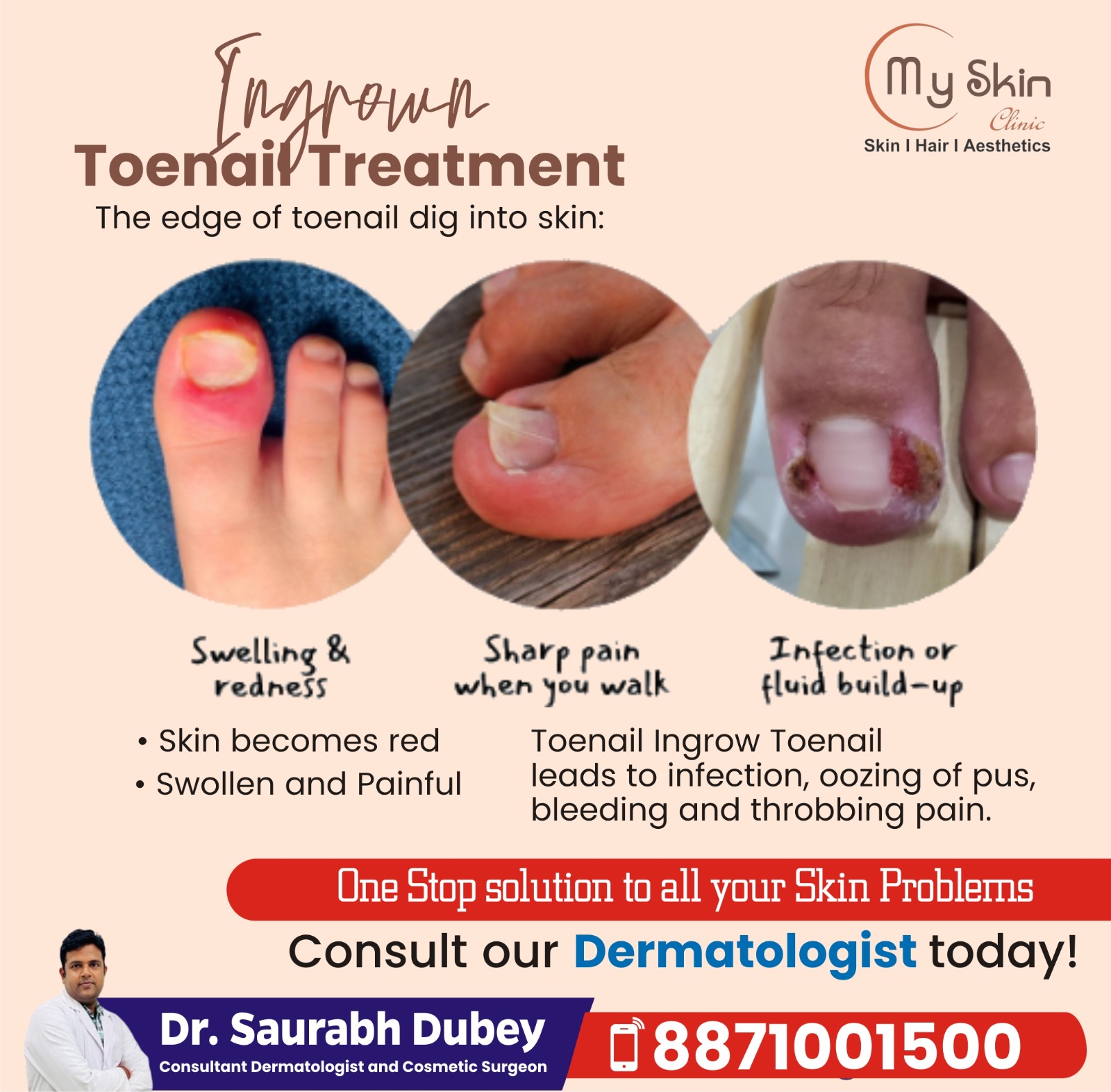 Ingrown Toenail Treatment In Indore