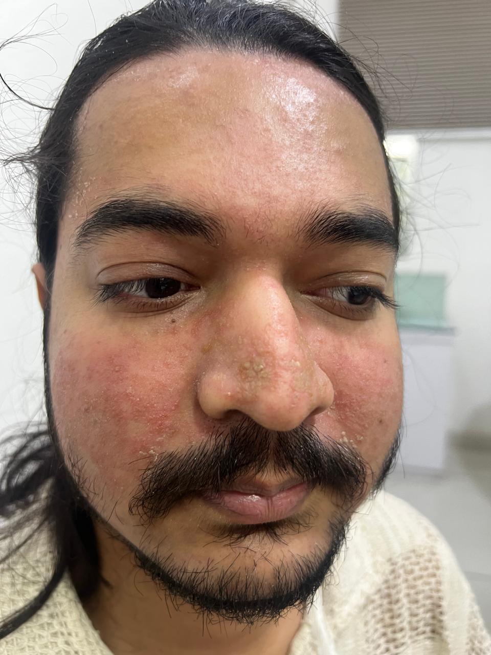 Best Skin Specialist in Indore