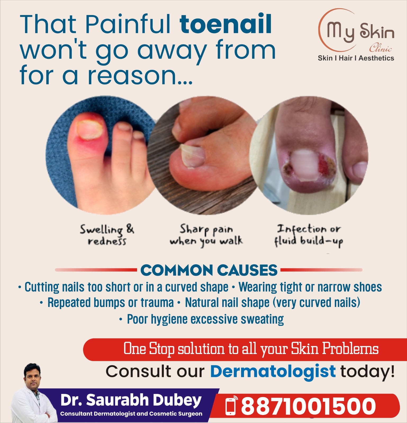 Ingrown Toenail Treatment in Indore 