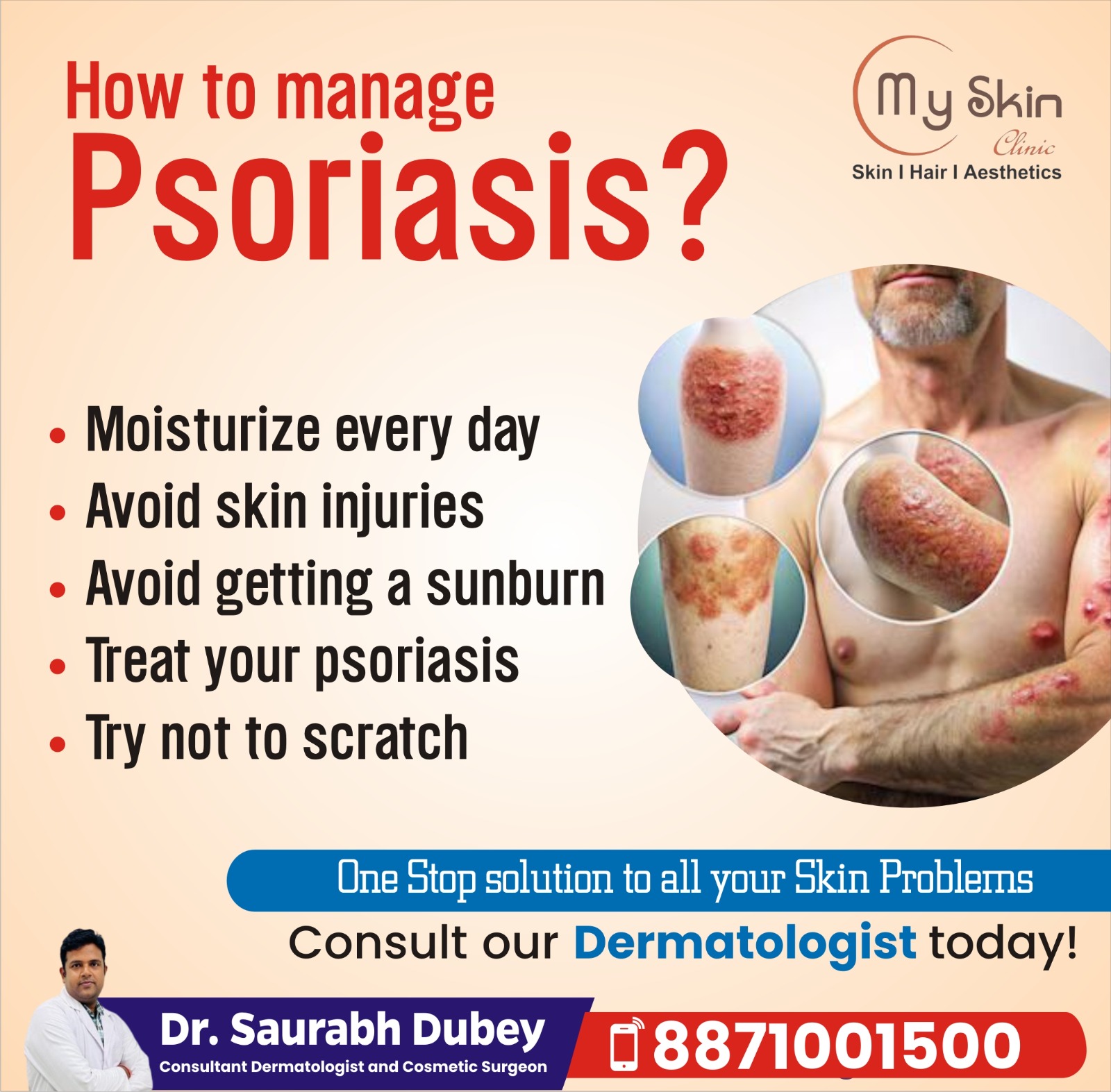 Psoriasis   Types  causes and Treatment options