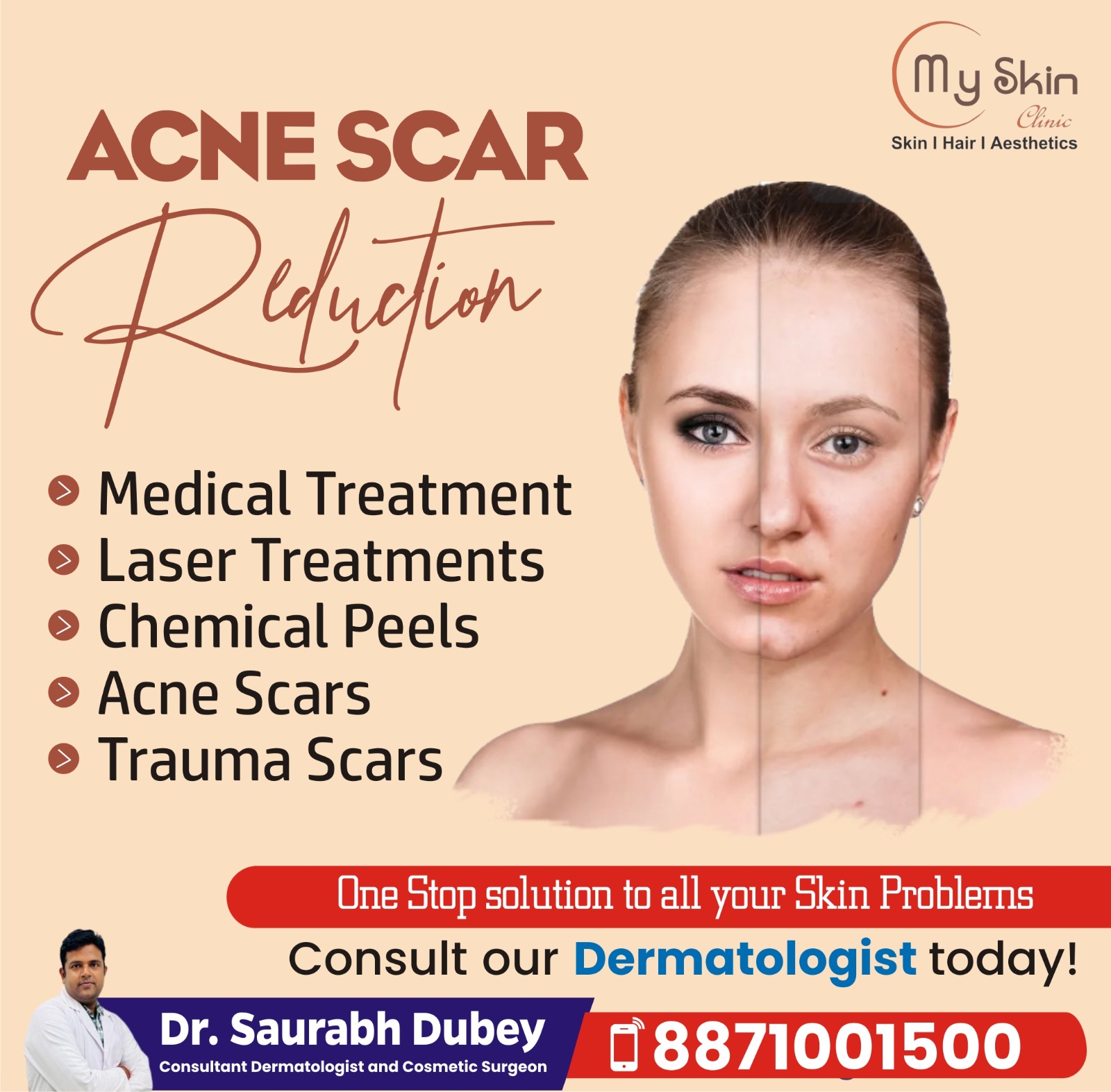 Best Skin Doctor for Acne Scars Treatment In Indore