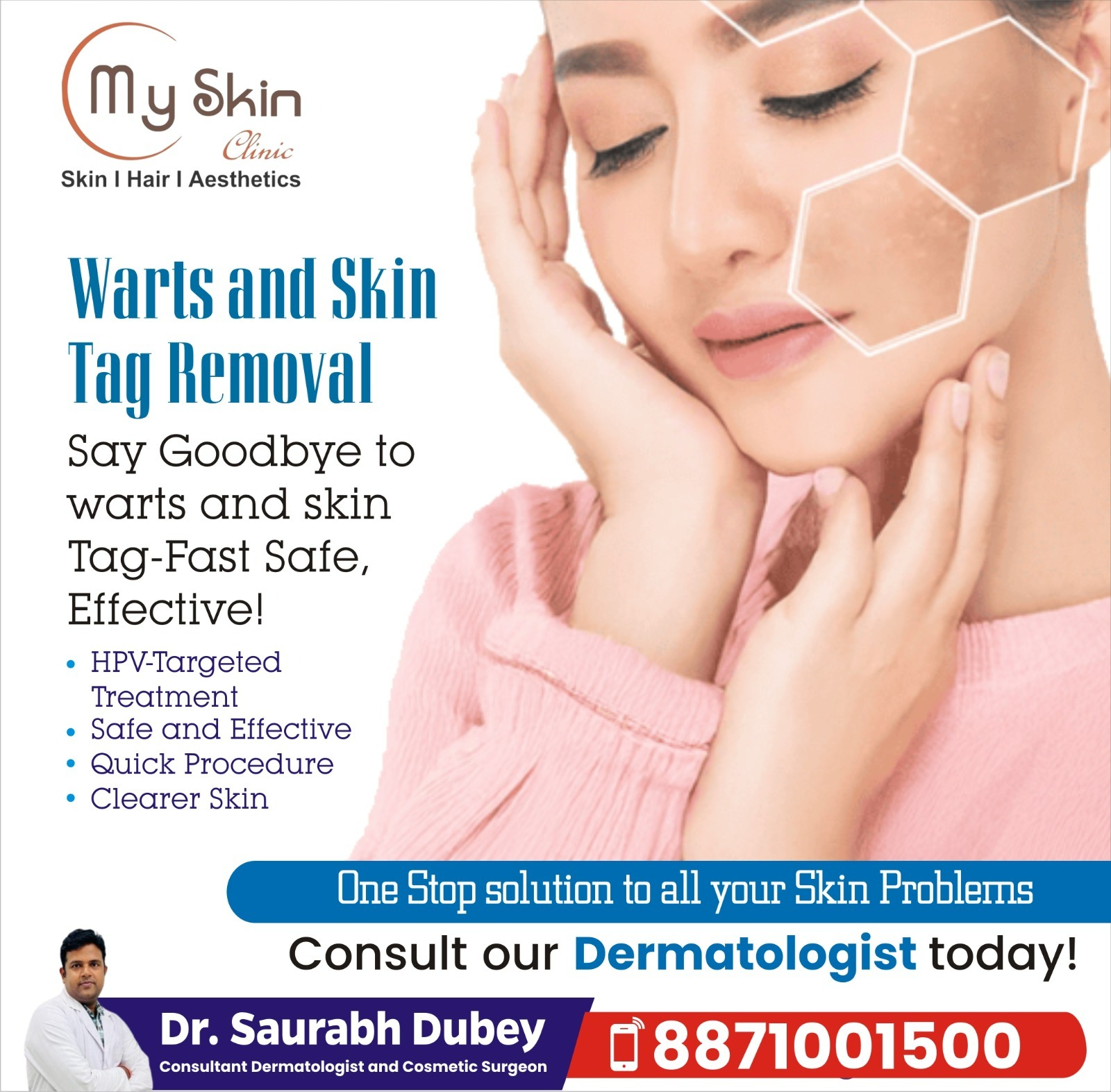 Warts and Skin  Tag Removal Expert in indore
