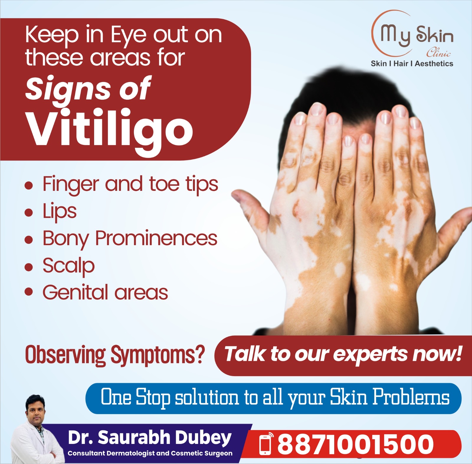 Best Doctor for Vitiligo Treatment in Indore