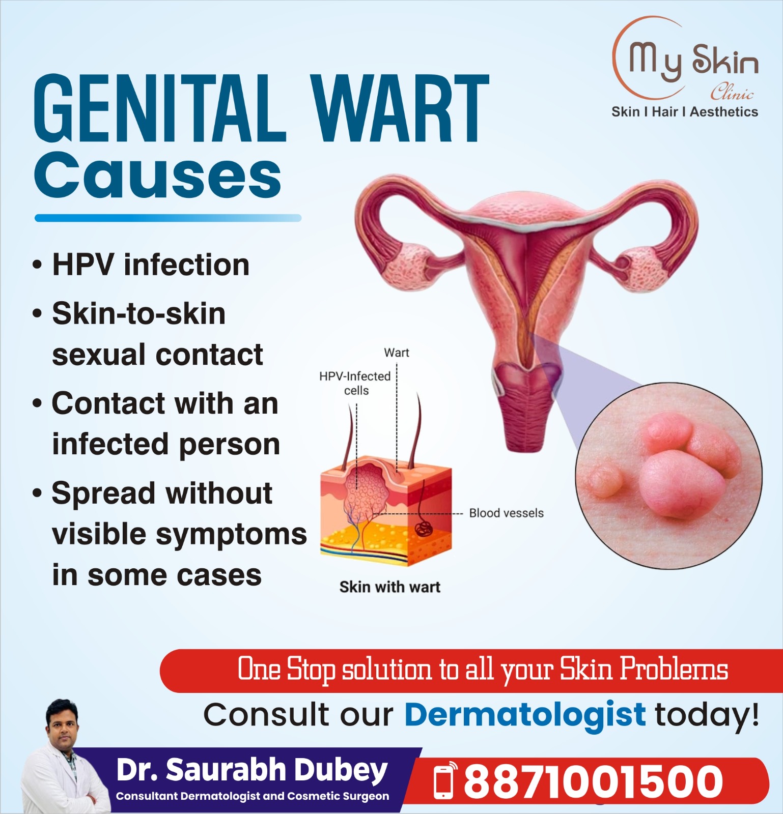 Genital Warts Removal Treatment in Indore