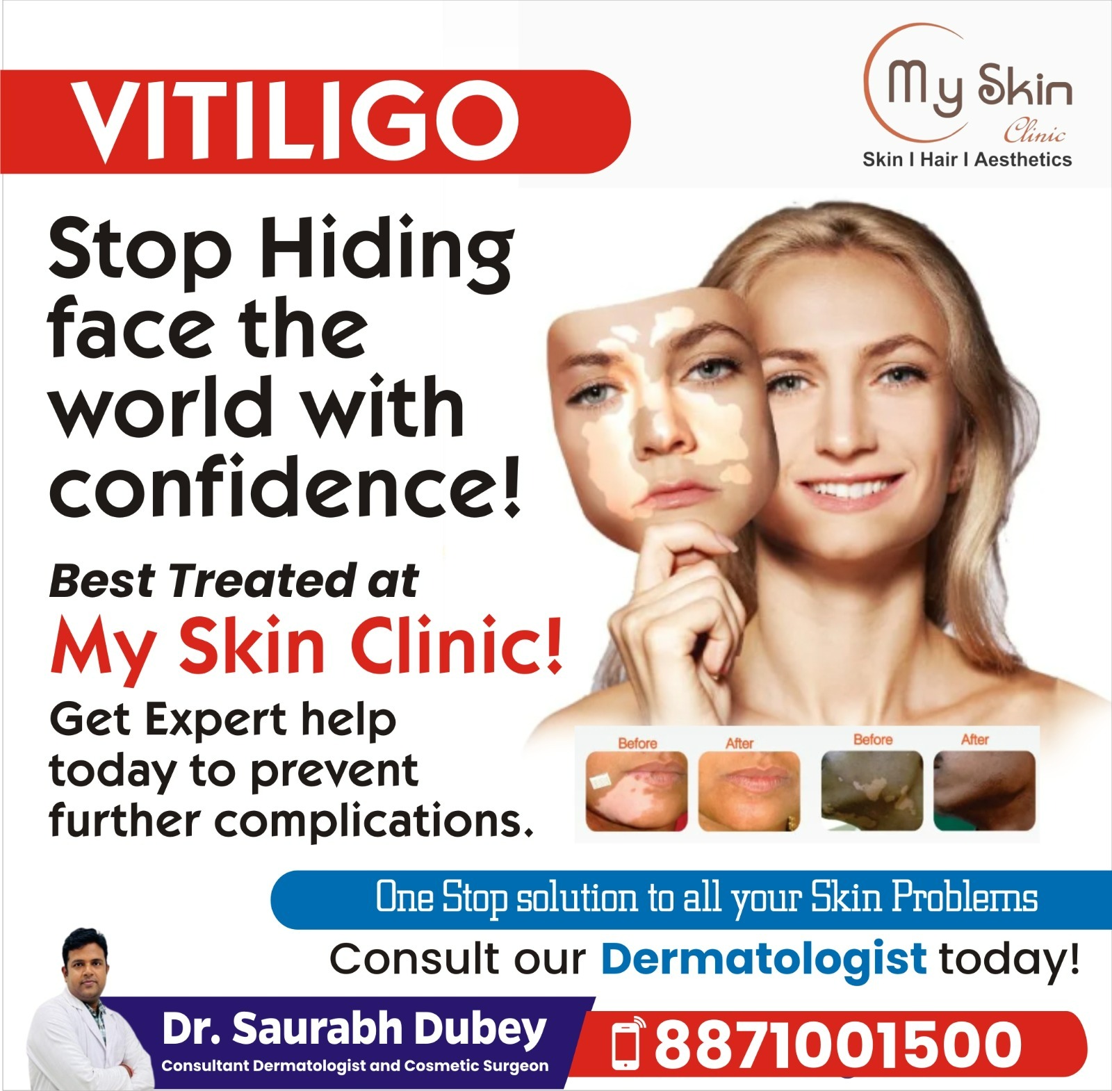 Best Doctor For Vitiligo Treatment In Indore