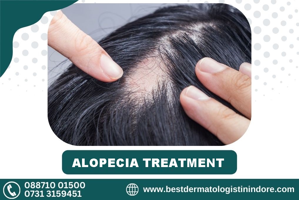 Best Doctor for Alopecias Treatment in Indore